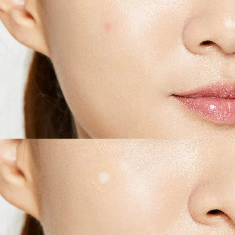 [COSRX] Acne Pimple Master Patch
