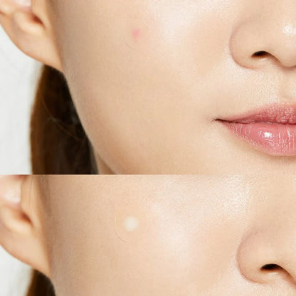 [COSRX] Acne Pimple Master Patch
